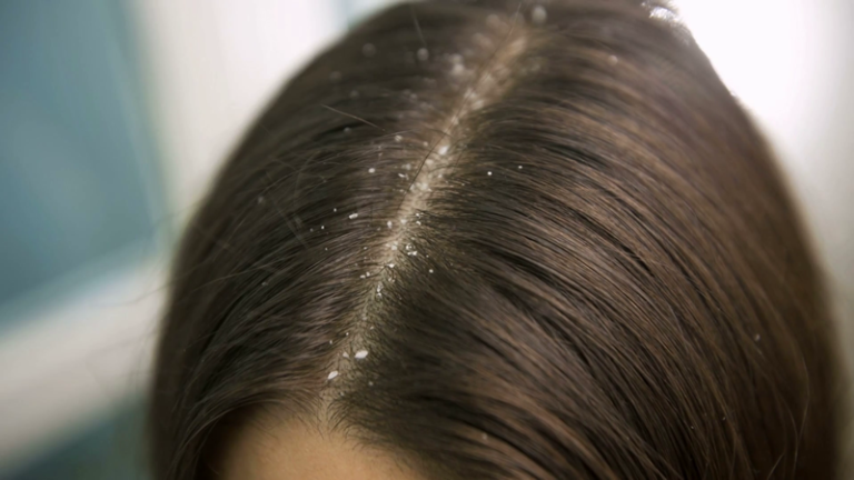 Hair care for Dandruff | Dandruff Home Remedy