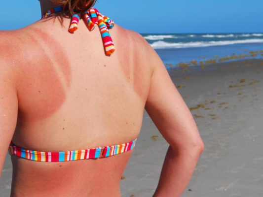 How To Treat Sunburns